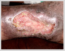 Leg Ulcer